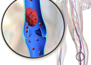 Blausen_0290_DeepVeinThrombosis