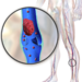 Blausen_0290_DeepVeinThrombosis