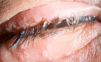 Comprehensive Information on Herpes